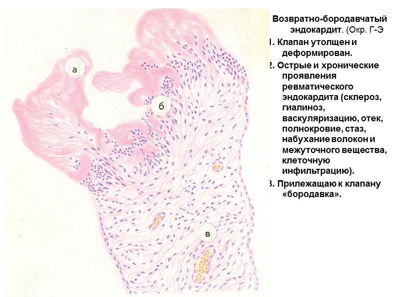 Возвратно-бородавчатый эндокардит. (Окр. Г-Э 1. Клапан утолщен и деформирован. 2. Острые и хронические проявления